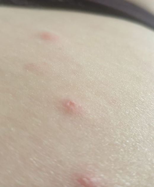 How To Identify 10 Of The Most Common Bug Bites – Celebs News